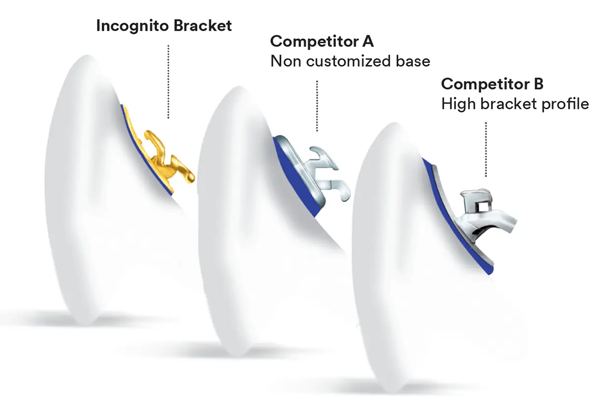 Most low profile lingual bracket making it