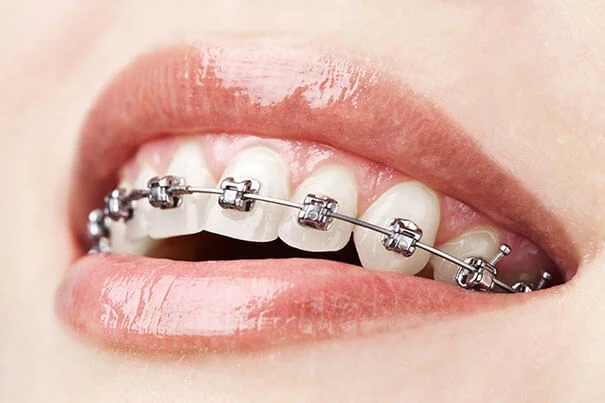 Orthodontics self locking