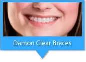 this is Braces