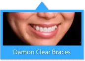 this is Braces